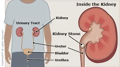 Diagnosis of childhood urinary tract stones