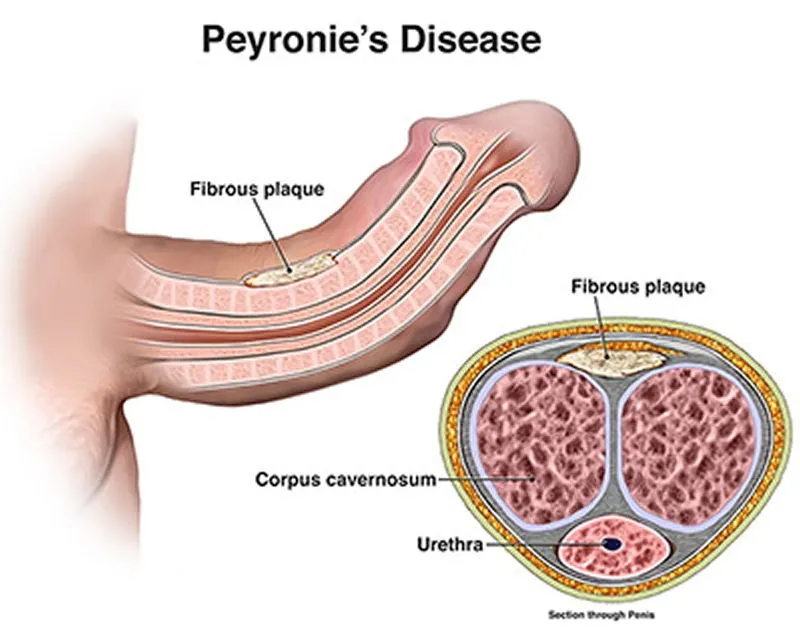 Peyronie disease